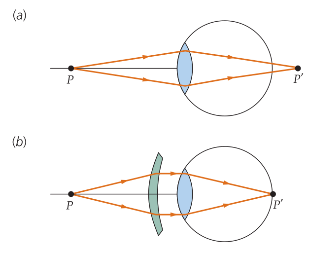 Na hipermetropia, a luz incidente  é focalizada em um ponto atrás retina. Nesse caso, deve ser usada uma lente convergente.